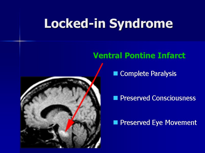 Locked-in Syndrome Ventral Pontine Infarct  Complete Paralysis   Preserved Consciousness  